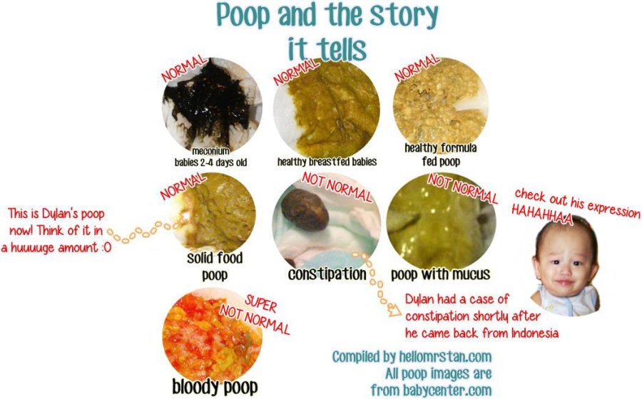 Constipation in newborn nhs