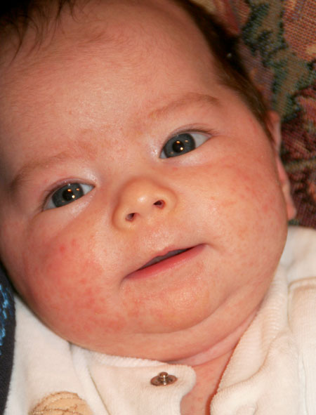 Meningitis rash infant