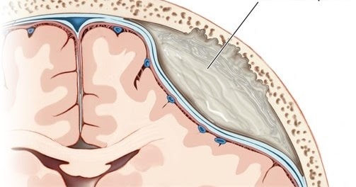 Epidural drip during labor