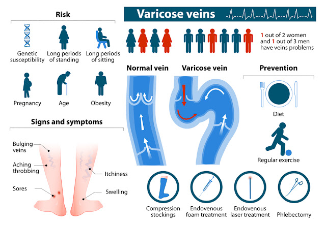 What helps varicose veins during pregnancy