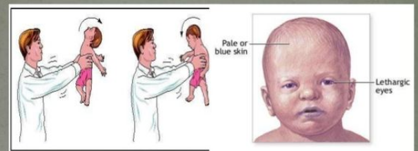 Shaking a baby can cause