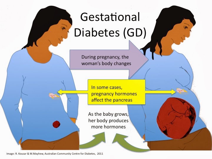 Overactive thyroid and pregnancy