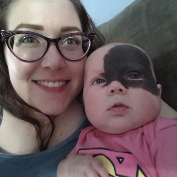 Red birthmark on baby's face