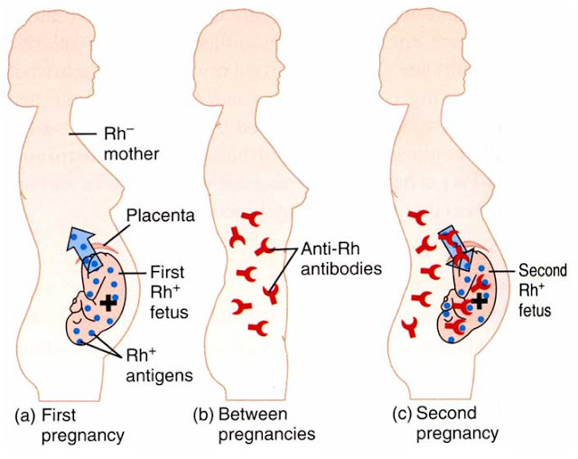 What is rhesus disease