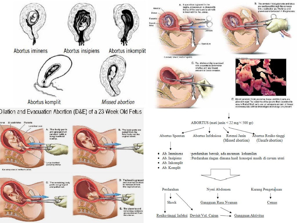 Types of abortions procedures