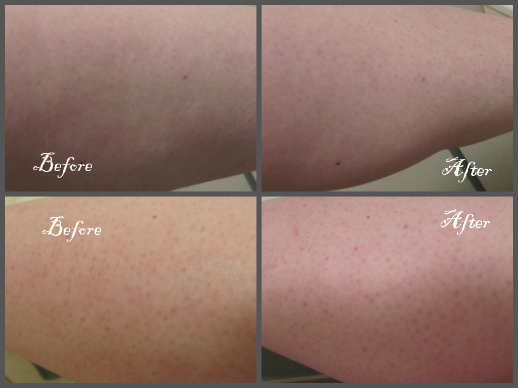 Keratosis pilaris pregnancy