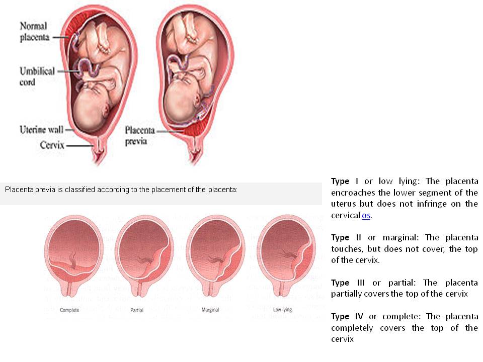 Signs of low lying placenta