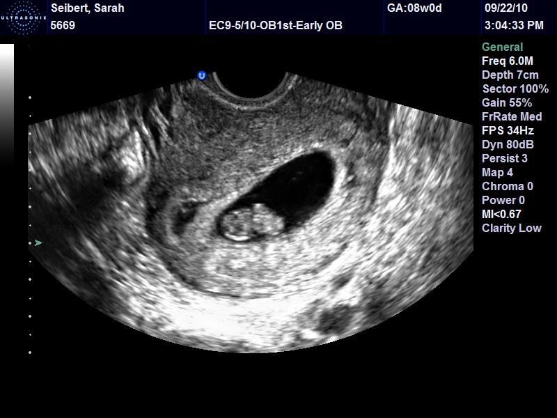 Miscarriage ultrasound 8 weeks