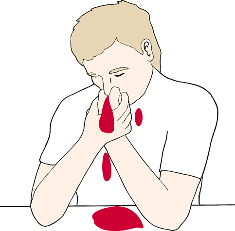 Signs of nose bleeding