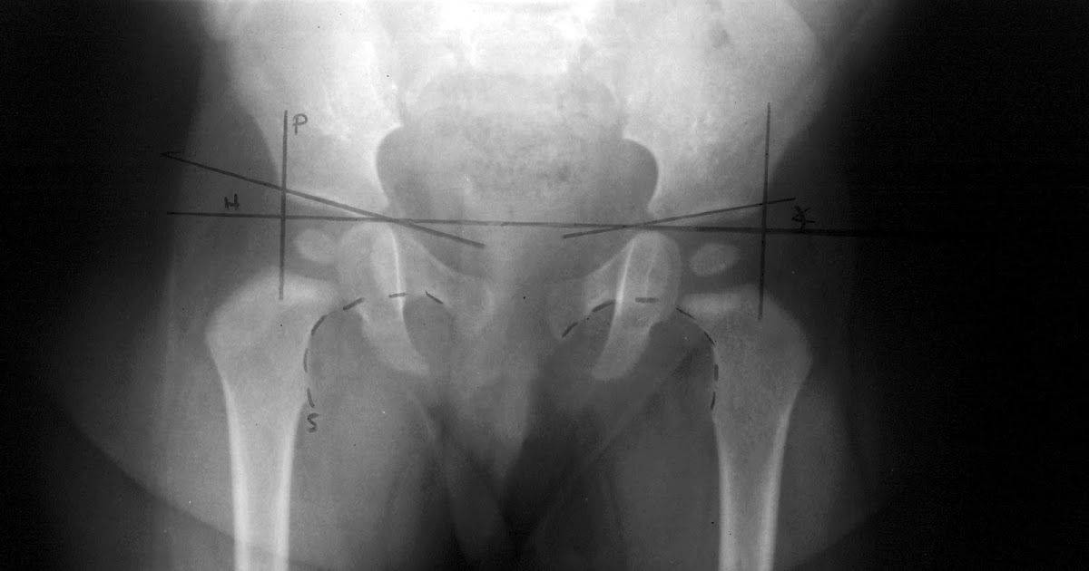 Mild hip dysplasia