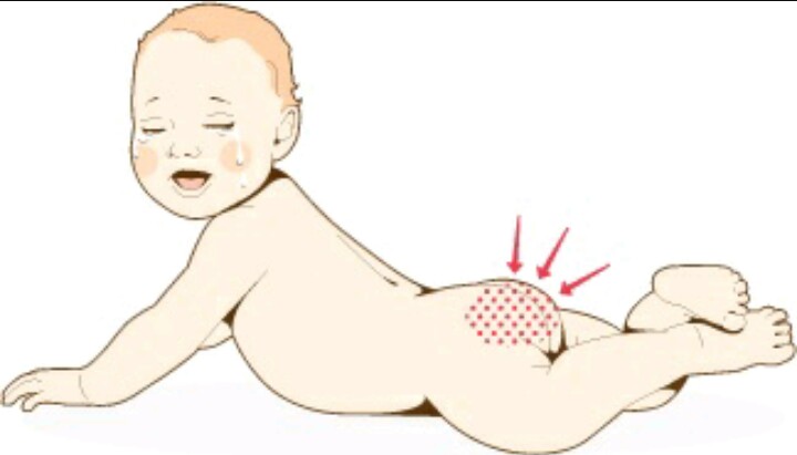 Rash on infant trunk