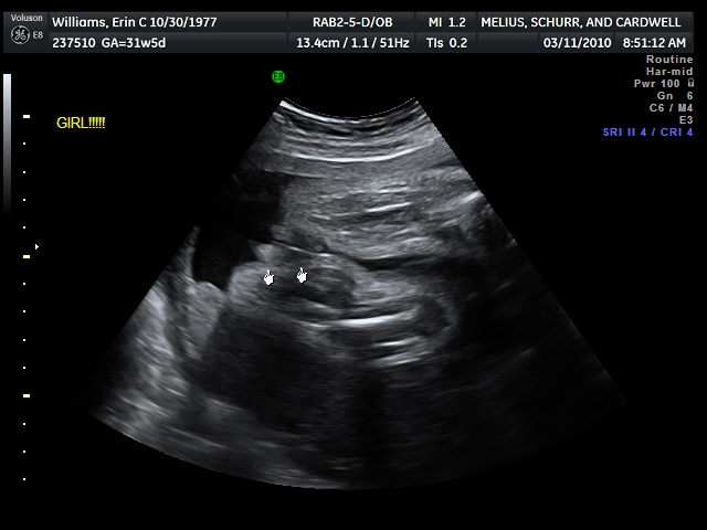 32 week gestation weight