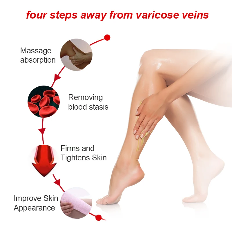 Painful varicose veins in pregnancy