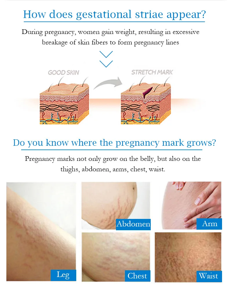 How long do stretch marks last