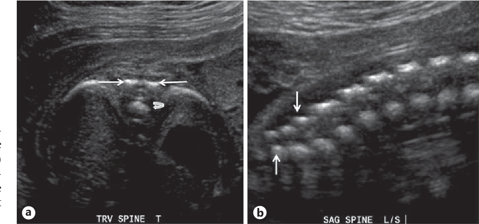 When can you see spina bifida in ultrasound