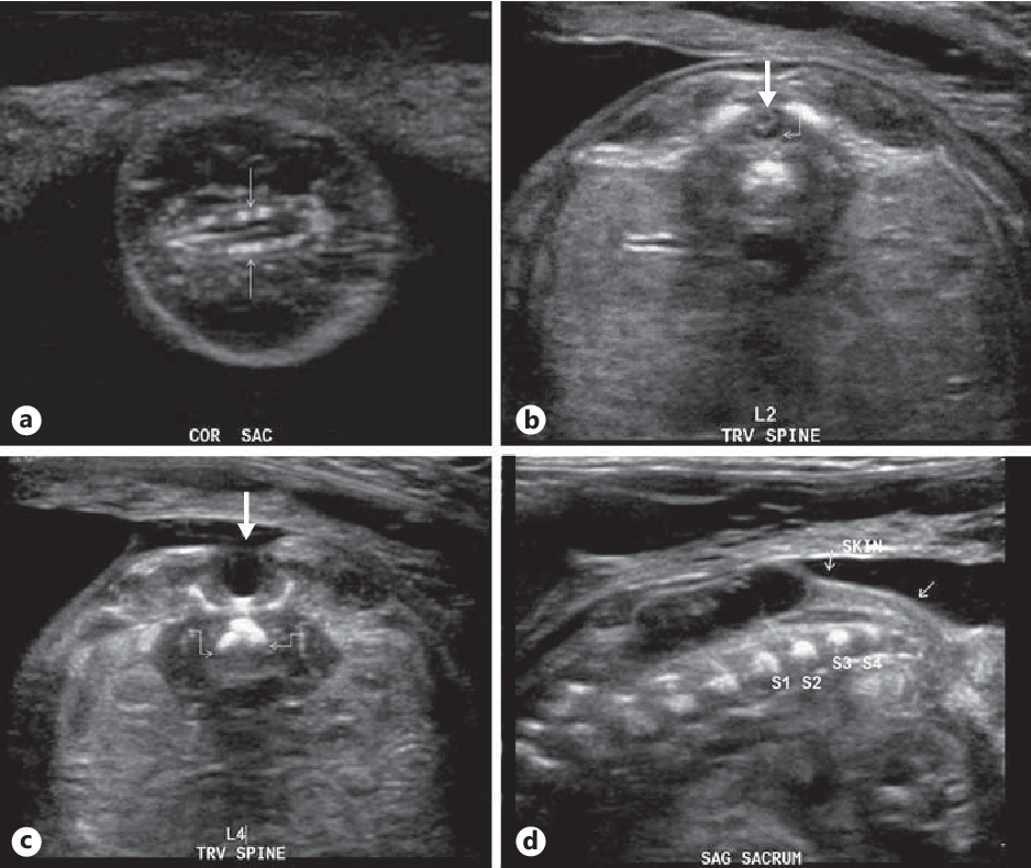 Can you see spina bifida on an ultrasound