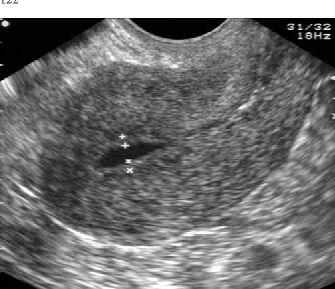 Is transvaginal ultrasound safe