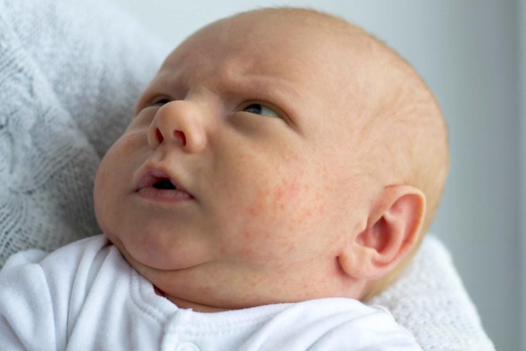 Baby skin rashes pictures