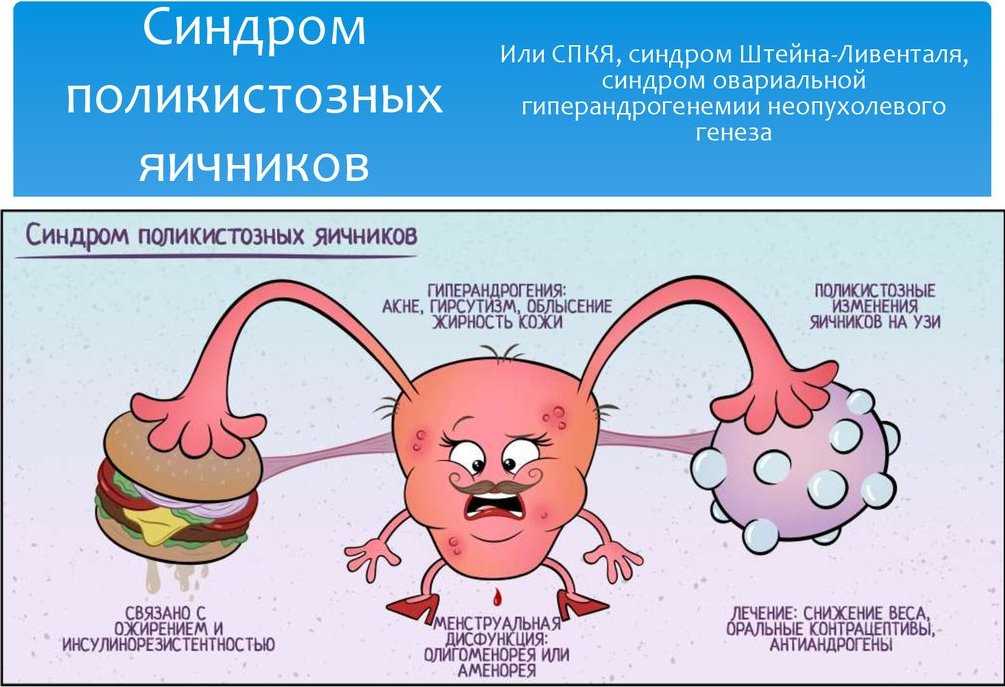 Pregnancy with polycystic ovary