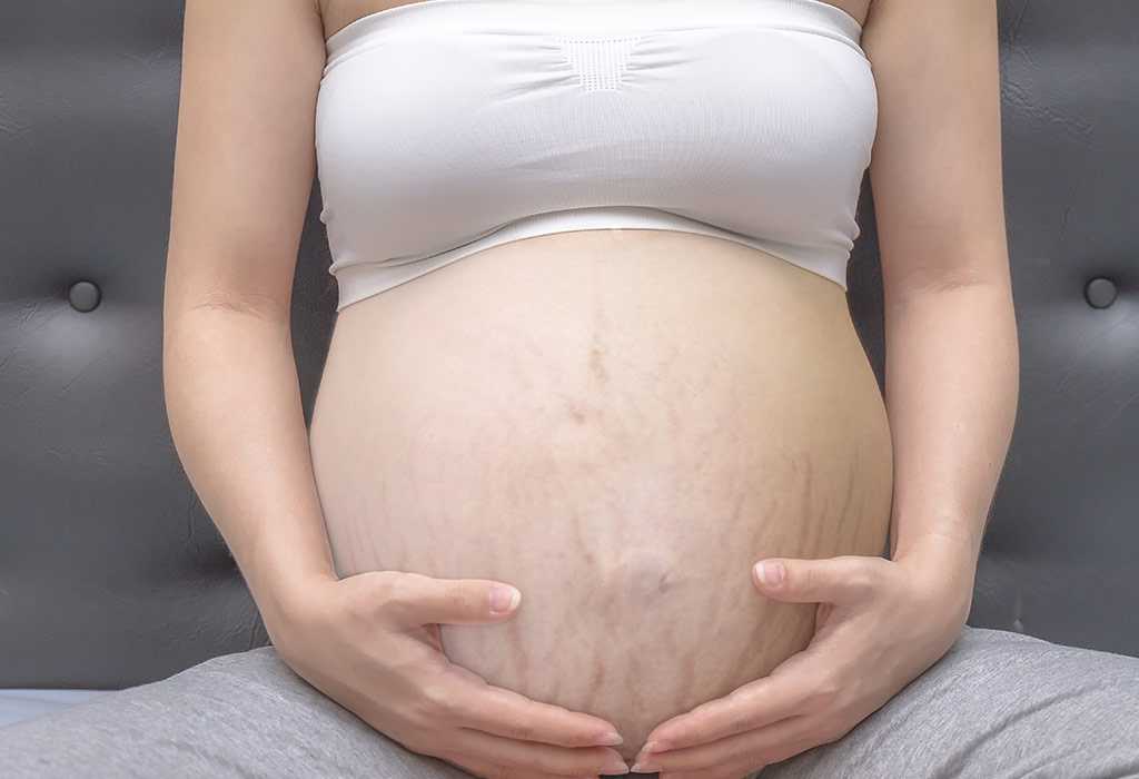 How to avoid stretch marks pregnant