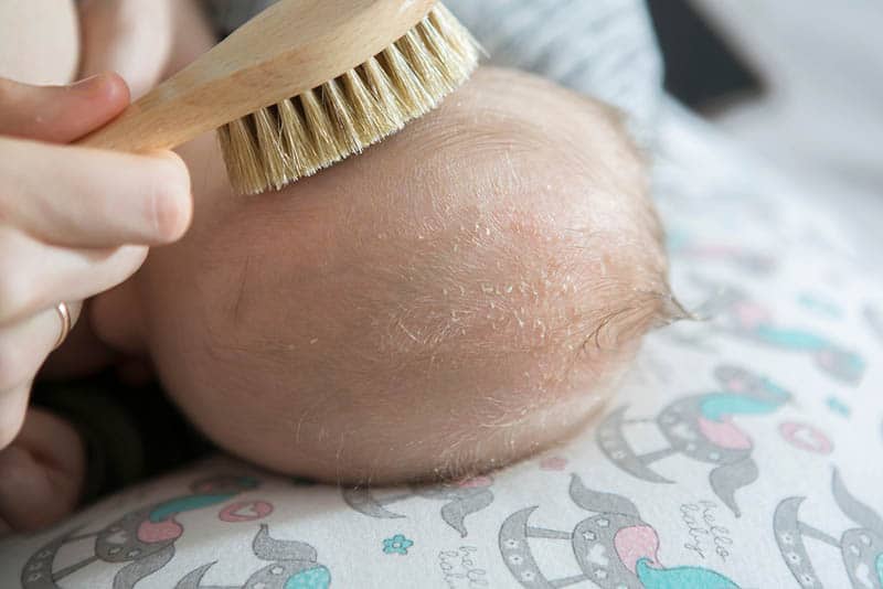 Cradle cap redness