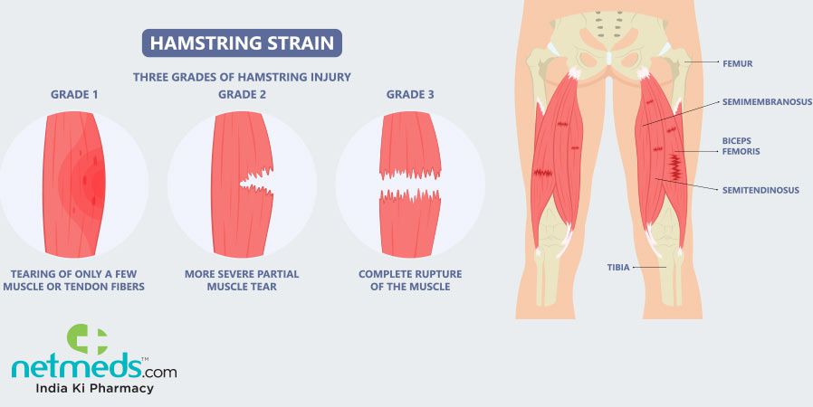 What to do about severe leg cramps