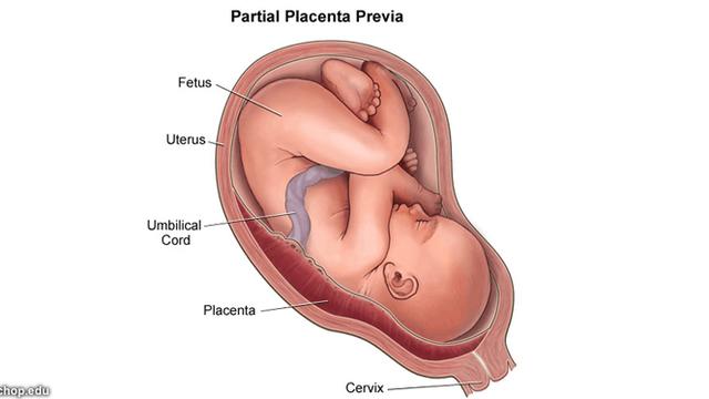 Umbilical cord detaches from placenta