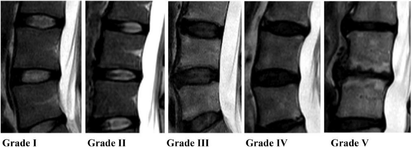 Degenerative disc disease pregnancy