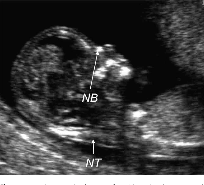 Nuchal translucency nt