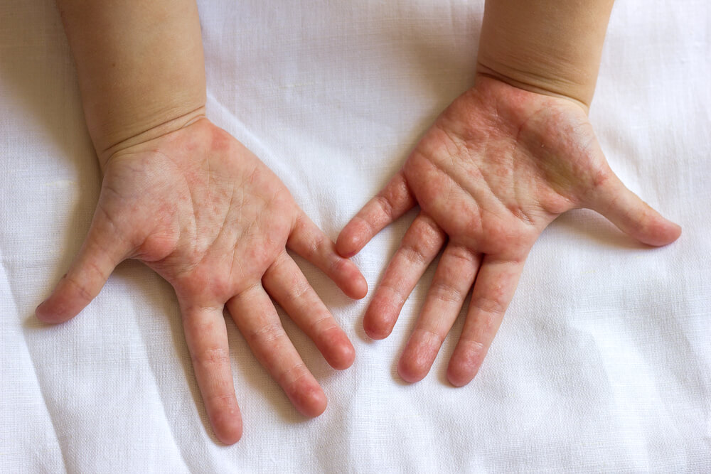 Blanching rash in children