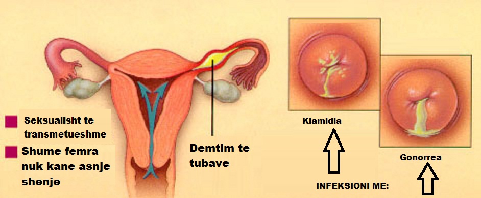 Pictures of women with chlamydia