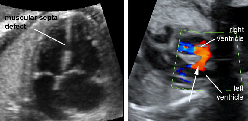 Birth defect ultrasound