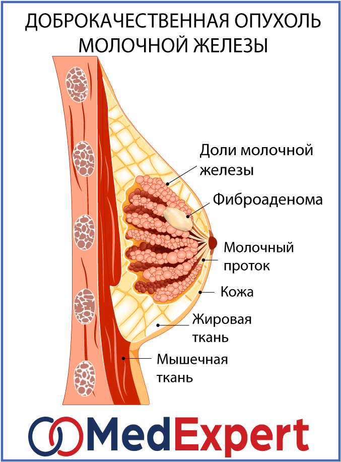 Open sores on breast