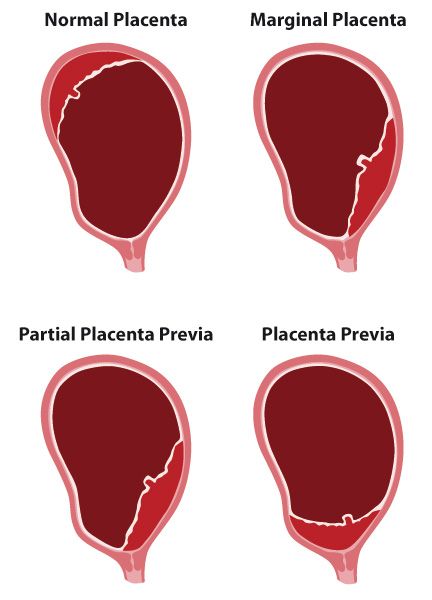 Bleeding after labor