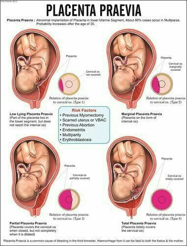 What is a retained placenta