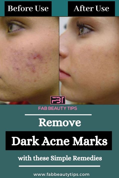 Dark spots on face after pregnancy