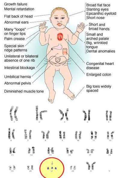 Most common congenital abnormality