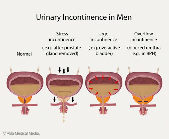 Stress incontinence in pregnancy