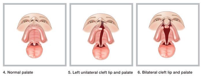 Prevent cleft lip