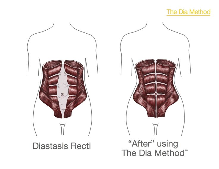 How to tell if abdominal muscles are separated