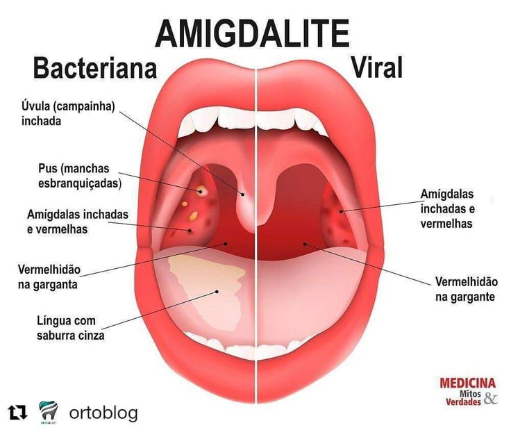 How to know if my child has strep throat