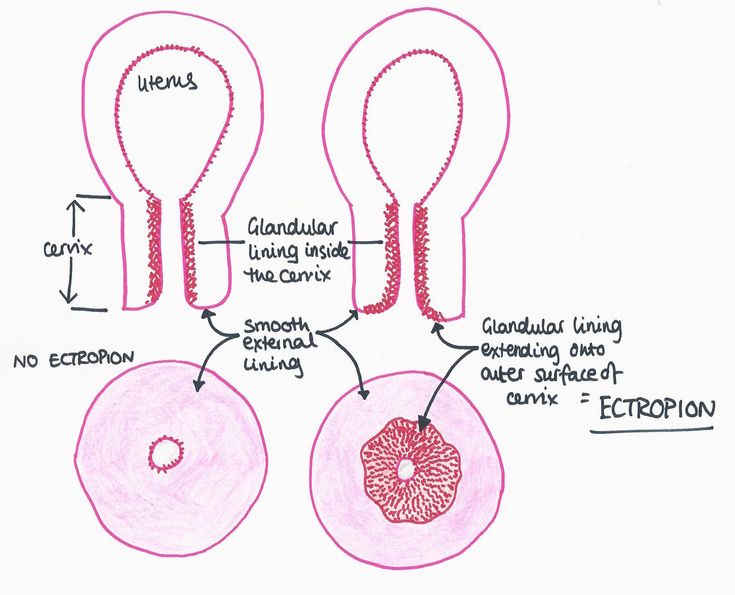 Bleeding during ectopic pregnancy