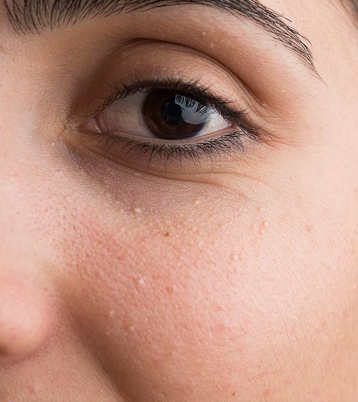 Child with small bumps on skin