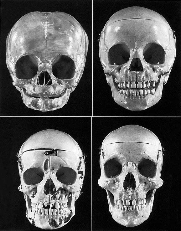 When does a baby skull close