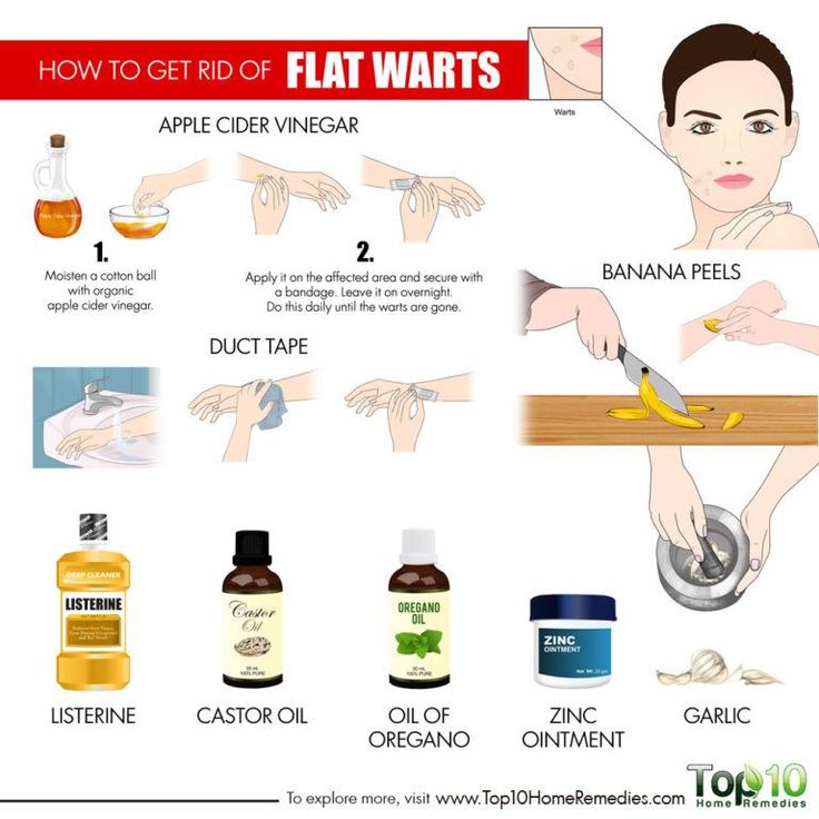 How to get rid of warts on child