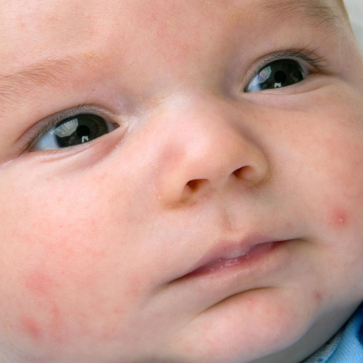 Small red bumps on child