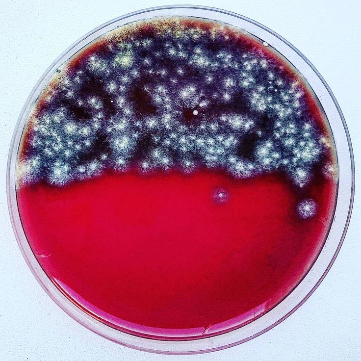 Effects of listeria on fetus