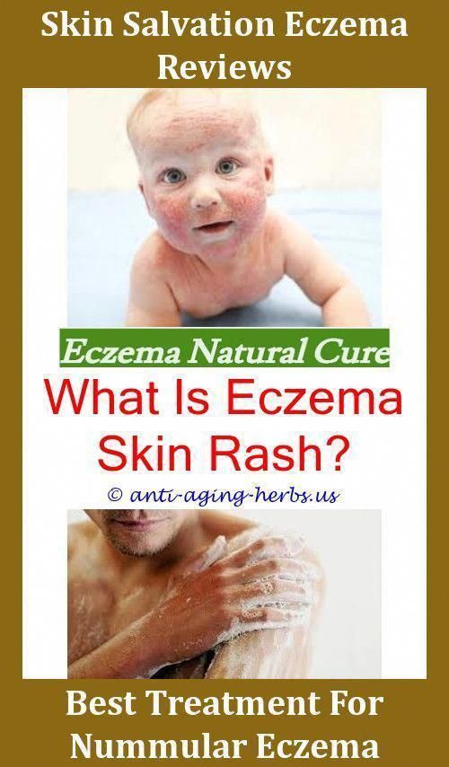 Infant skin rash on face