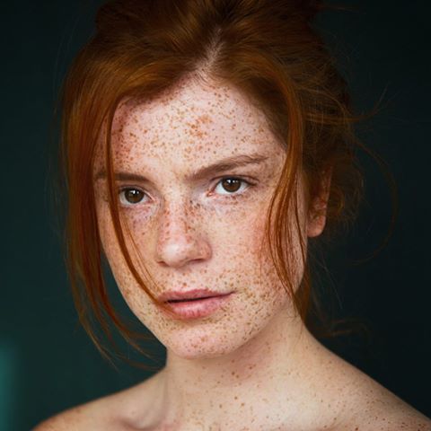 Freckles during pregnancy