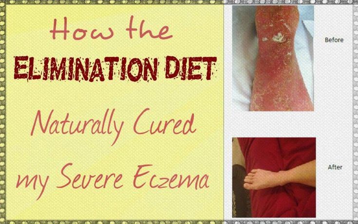 Cure for eczema on babies